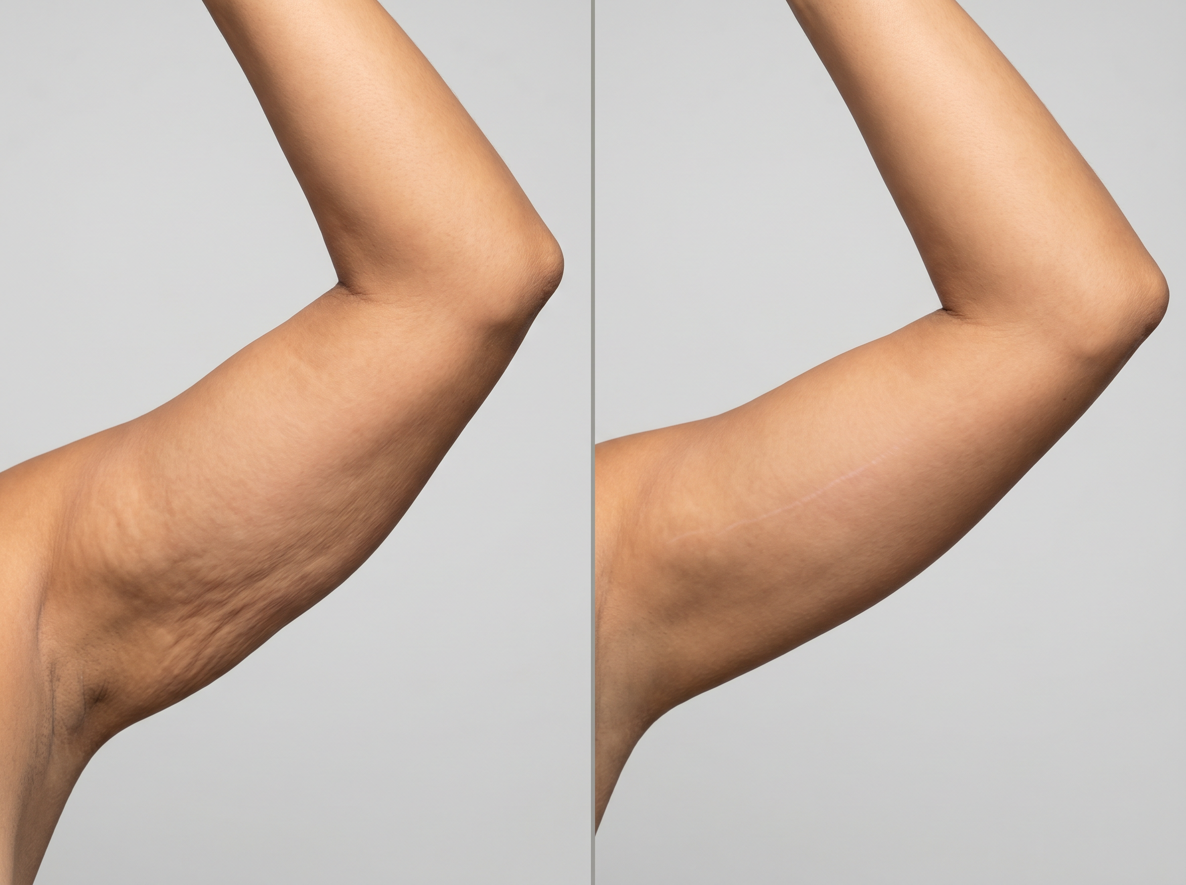 Arm lift result