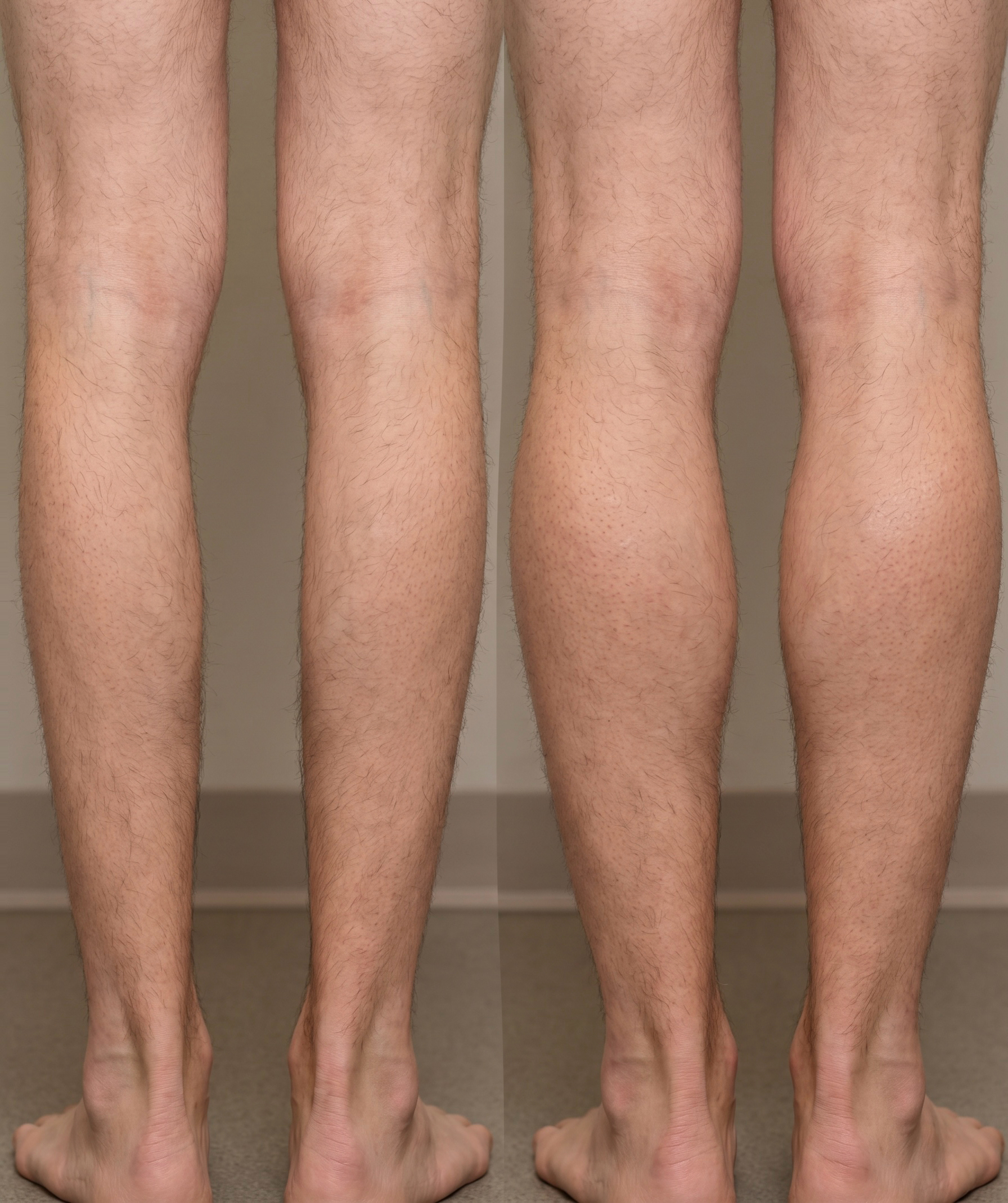 Calf contouring result